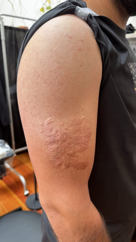 Large arm scar